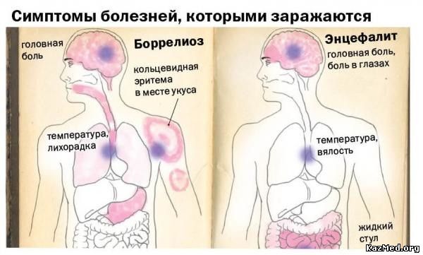 Берлиоз болезнь симптомы и лечение. Клещевой боррелиоз мигрирующая эритема. Боррелиоз это боррелиоз клещевой. Лайм боррелиоз мигрирующая эритема. Боррелиозный клещ укусил симптомы.