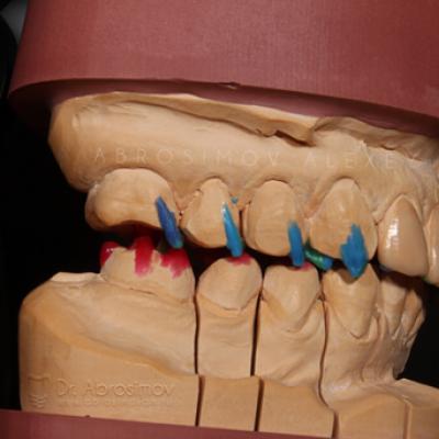 Comment la modélisation des dents à partir de cire